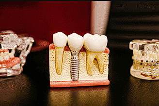 Proporcionamos soluciones de prótesis dentales, como dentaduras y puentes, para restaurar la funcionalidad y estética de tu sonrisa.